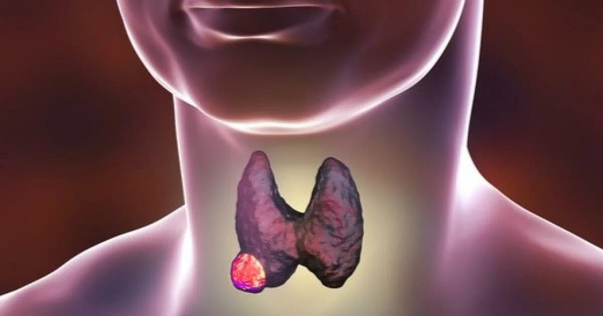 Рак щитовидной сколько живут