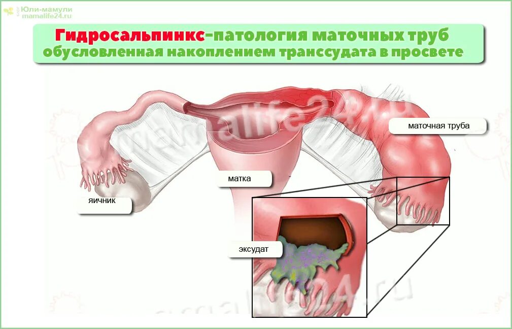 Труба после внематочной. Внематочная с удалением трубы. Удаление маточной трубы. Зачатие с одной трубой после внематочной беременности. Удалили трубу можно ли забеременеть