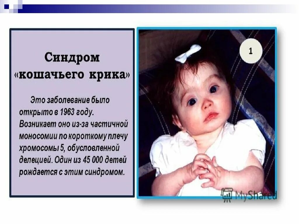Что такое синдром крика. Делеция 5 хромосомы синдром кошачьего крика. дети с синдромом кошачьего крика.