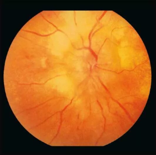 Ретинопатия хориоретинит. Гипертоническая ретинопатия глазное дно. Кандидозный хориоретинит.