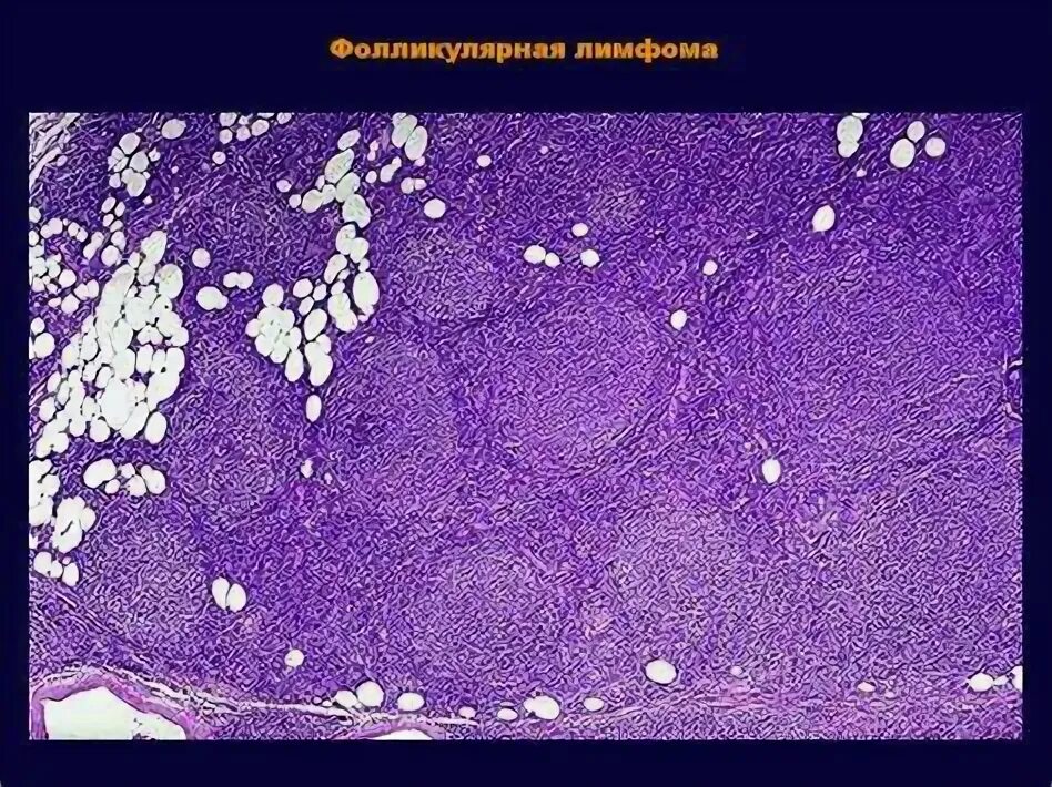 Фолликулярная кератома гистология. Лимфатический узел при вич инфекции микропрепарат. Фолликулярная гиперплазия лимфоидной ткани. Фолликулярная гиперплазия лимфоидной ткани. Крупноклеточные ядра.