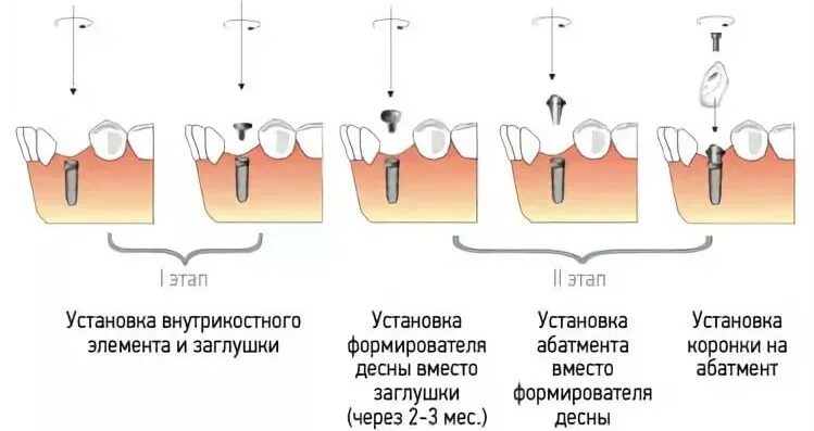 Через какое время можно вставить. Этапы установления имплантата зуба. Этапы установки импланта зубов. Имплант схема установки. Двухэтапная методика имплантации зубов.