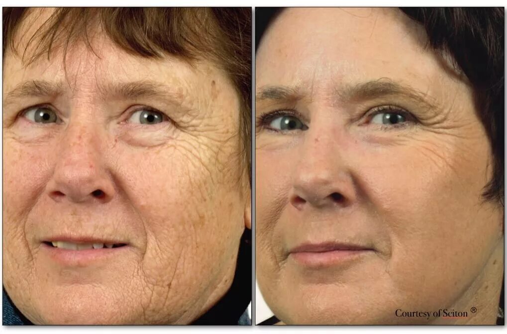 Омоложение лица до и после. Морщины до после. Фракционный лазерный пилинг. Лазерный отзывы пациентов