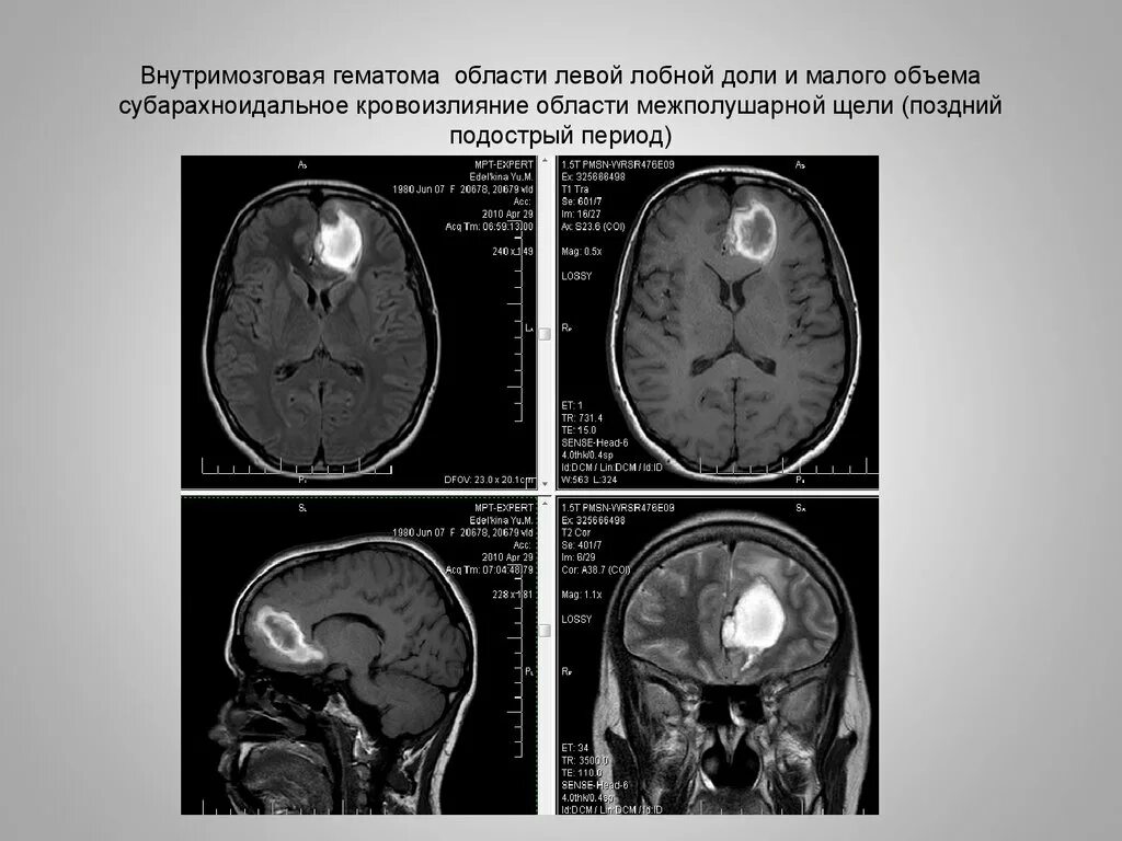 Образование в лобной доле. Субарахноидальное кровоизлияние межполушарной щели. Внутримозговая гематома мрт. Субарахноидальное кровоизлияние на кт межполушарной. Внутримозговая гематома лобной доли.