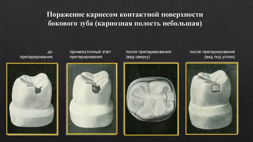 Препарирование зуба по блэку. Препарирование зуба по блэку