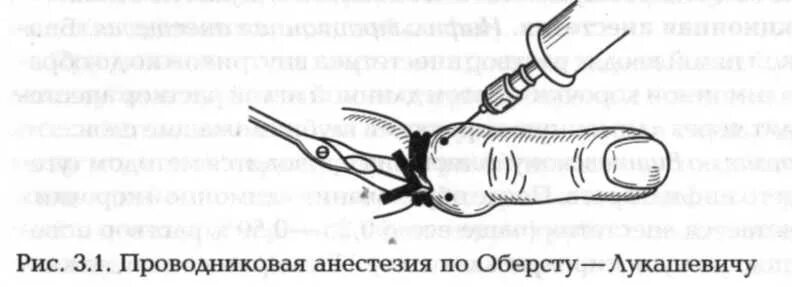 Проводниковая анестезия Лукашевичу Оберсту. Местная анестезия по Оберсту-Лукашевичу. Блокада по Оберсту-Лукашевичу. Инфильтрационная анестезия схема. Что такое проводниковая анестезия