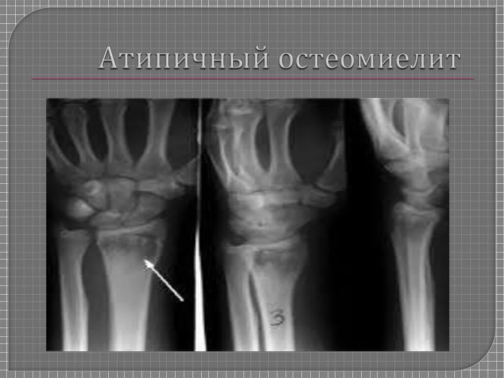 Атипичный остеомиелит. Атипичные формы хронического остеомиелита. Остеомиелит олье рентген. Остеомиелит гарре гистология. Формы острого гематогенного остеомиелита.