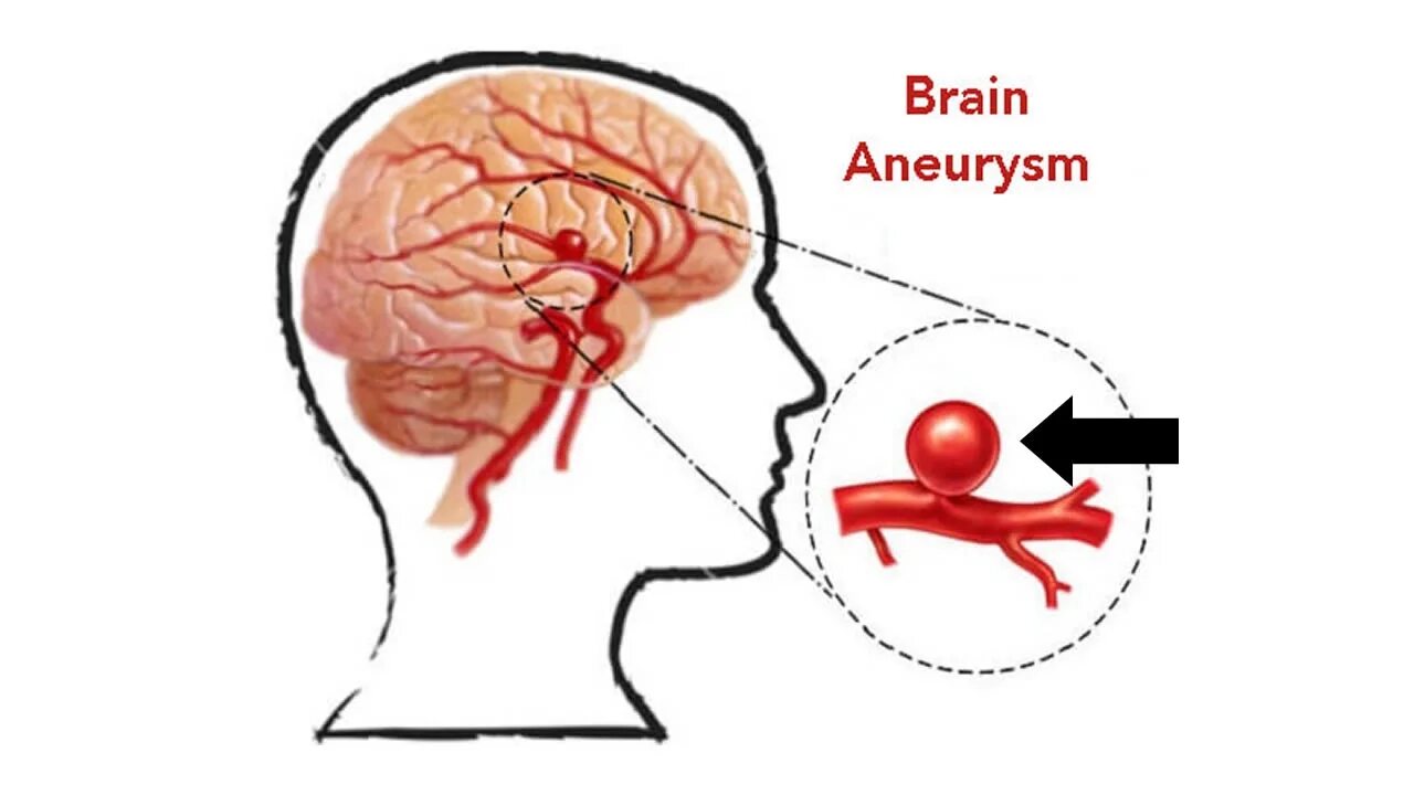 Аневризмы головного мозга. Аневризма сосудов головного мозга. Аневризм сосудов головного мозга. Аневризма головного мозга схема. Аневризма мозга простыми словами
