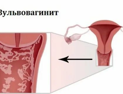 Клиническая молочница