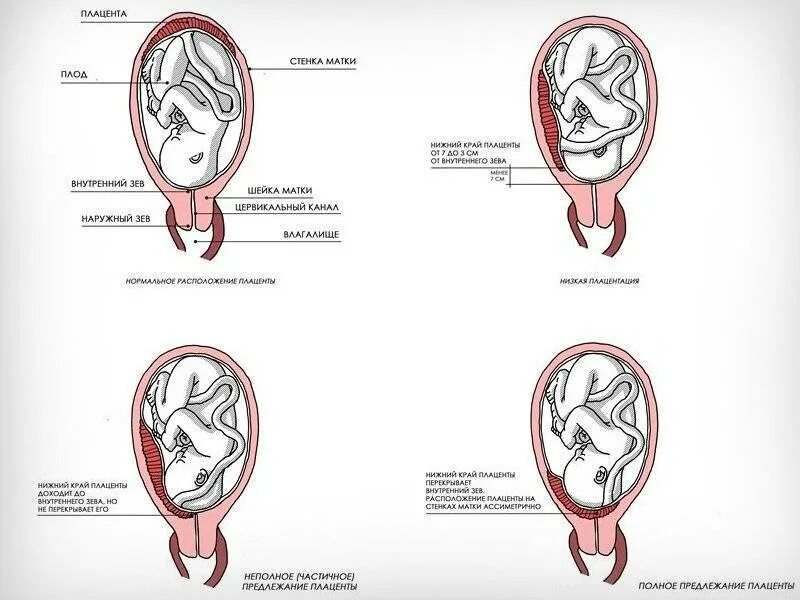 Что значит зев закрыт. Нижний край плаценты расположен на уровне внутреннего зева. Плацентация при беременности. Плацента 28 мм от внутреннего зева. Низкая плацента при беременности 15 недель.