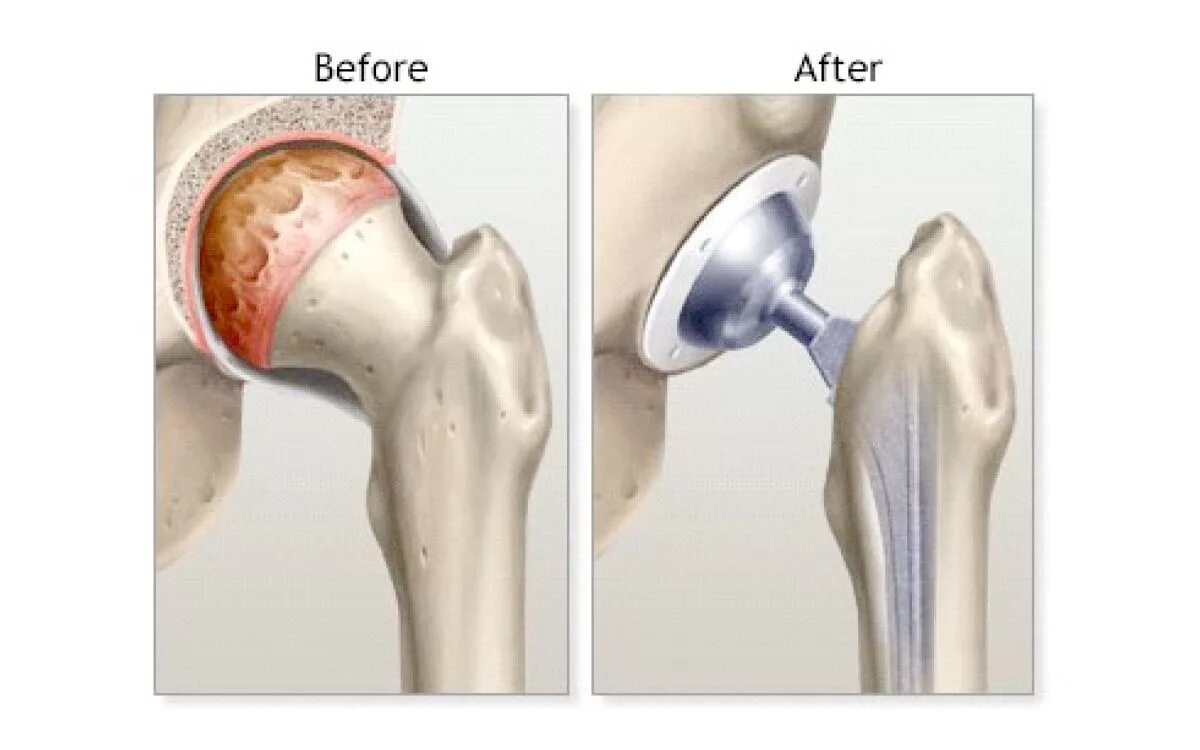 Цементный эндопротез тазобедренного сустава. Эндопротез коленного сустава Титан. Эндопротез цементной фиксации коленного сустава. Эндопротезирование сустава ВНЧС. Как происходит операция по замене тазобедренного сустава