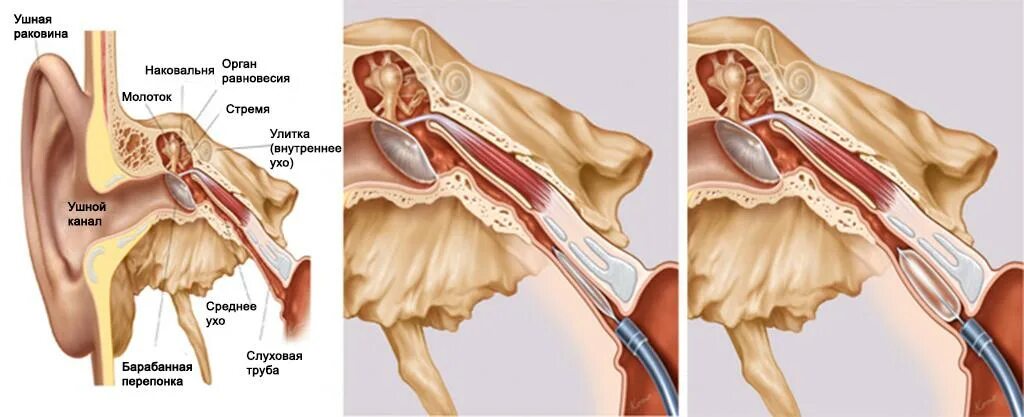 Заложенность уха тубоотит. Слуховая евстахиева труба. Евстахиит воспаление слуховой трубы. Евстахиит барабанная перепонка. Воспаление слуховой евстахиевой.