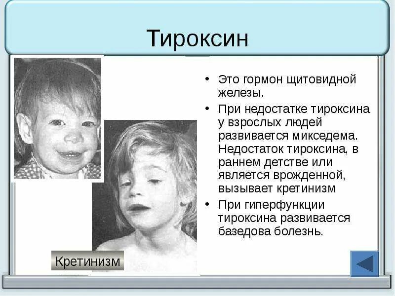 Заболевание при недостатке тироксина. Что развивается при недостатке гормона тироксина у взрослых. Гиперфункция щитовидной железы тироксин. Принедостаьке тироксина развивается.