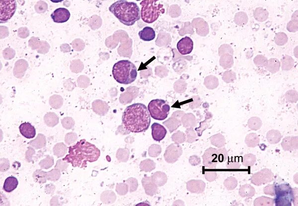 Гранулоцитарный эрлихиоз. Моноцитарный эрлихиоз. Ehrlichia chaffeensis/ Ehrlichia Muris клещ.