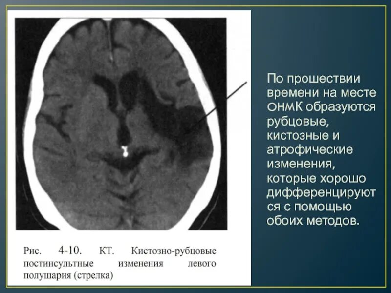 Кистозно атрофические изменения головного