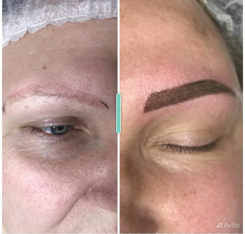 Татуаж бровей лазером. Брови после удаления перманентного макияжа. Выведение татуажа бровей лазером. Выведение татуажа бровей лазером. Синие брови после татуажа.