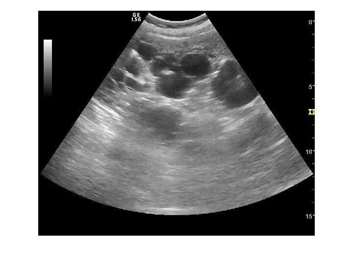 Колонка Бертини в почке что это на УЗИ. УЗИ почек Изранов. Повышенная эхогенность почек на УЗИ. Повышение эхогенности почек на УЗИ. Печень эхогенность неоднородная
