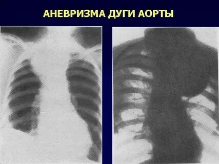 Расширение восходящей