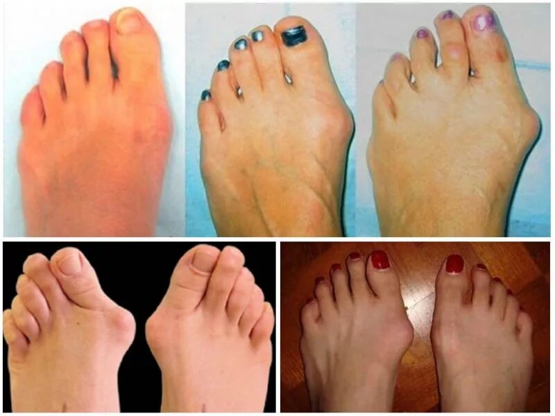 молоткообразная деформация. молоткообразная деформация пальцев ног. молоткообразная деформация. вальгус деформация большого пальца стопы. деформация стопы ног пальцы.