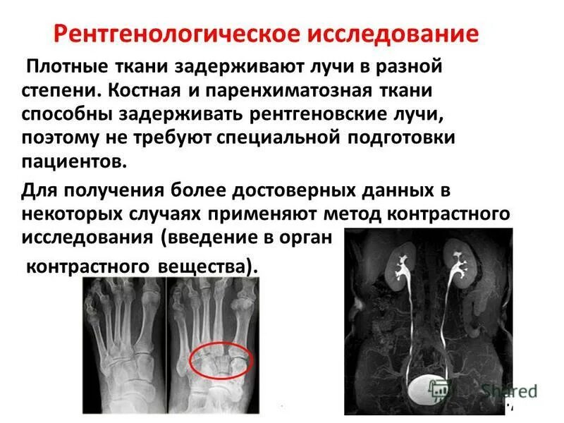 Рентгенологическому исследованию травмы. Рентгенологическому исследованию травмы. Рентгеносемиотика переломов. Рентген почек обзорная урография. Рентгенологическому исследованию травмы.