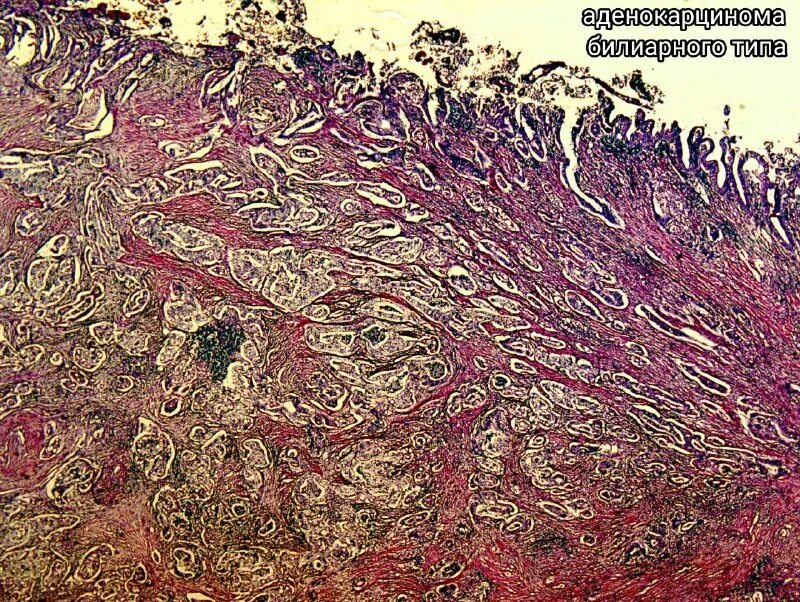 аденокарцинома желудка микропрепарат. аденокарцинома глисон 5+5 гистология. аденокарцинома желудка g3. аденокарцинома пилоруса гистология. аденокарцинома желудка гистология.