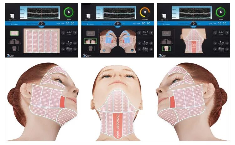 Схема ультразвукового смас лифтинга. Протокол смас лифтинга HIFU. Аппарат ультраформер смас. 3д смас лифтинг аппарат. Что лучше смас или рф