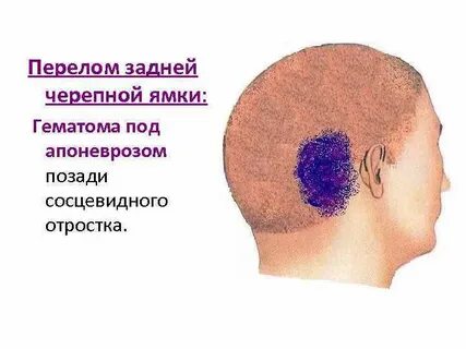 Переломы задней черепной ямки
