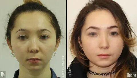 Операция по увеличению челюсти