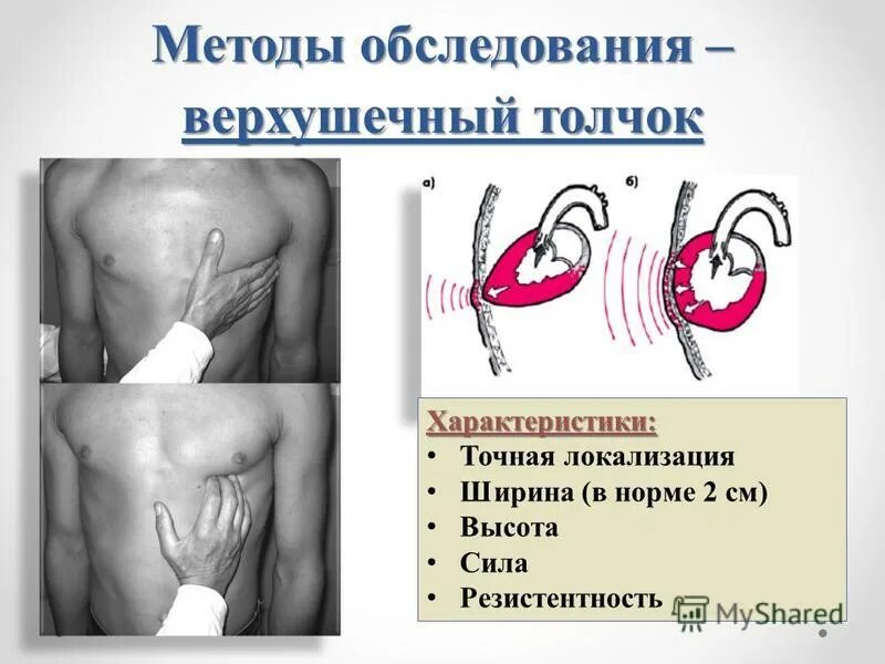 Пальпация верхушечного толчка. В норме верхушечный толчок определяется. В норме верхушечный толчок определяется. Сердечно сосудистая система верхушечный толчок. В норме верхушечный толчок определяется.