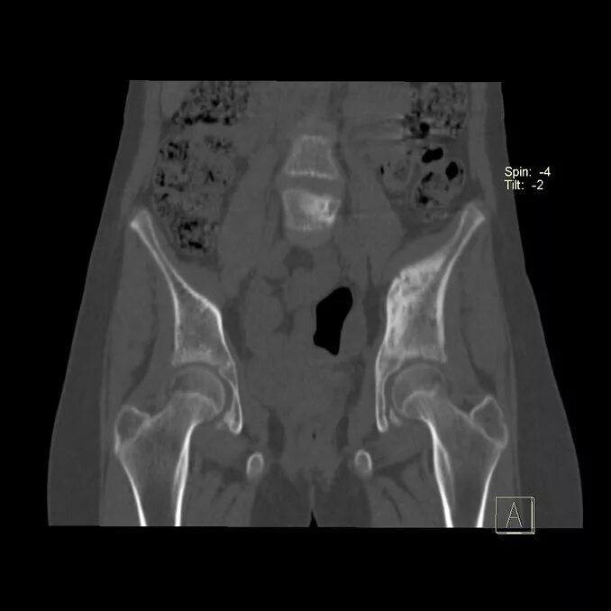 Кт подвздошной кости. Сакроилеит крестцово-подвздошного сочленения рентген. Туберкулезный сакроилеит кт. К-Т кре того подвздошного сочленения.