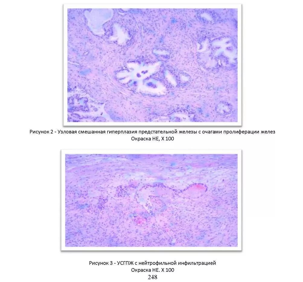 Гиперплазия предстательной железы препараты. Гиперплазия предстательной железы патанатомия. ДГПЖ предстательной железы гистология. Гиперплазия предстательной железы гистология. Доброкачественная гиперплазия предстательной железы макропрепарат.