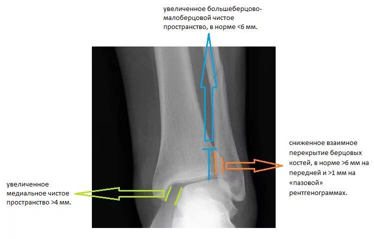 Разрыв межберцового синдесмоза рентген. Дистальный межберцового синдесмоза рентген. Разрыв дистального межберцового синдесмоза рентген. Перелом лодыжки синдесмоз. Операция малоберцовой кости