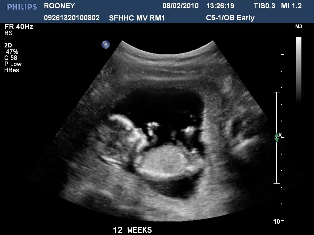 11 Недель беременности фото плода на УЗИ. УЗИ плода при беременности 12 недель. Как выглядит ребенок на УЗИ В 11 недель. УЗИ 11 недель беременности размер плода. Малыш на 12 неделе