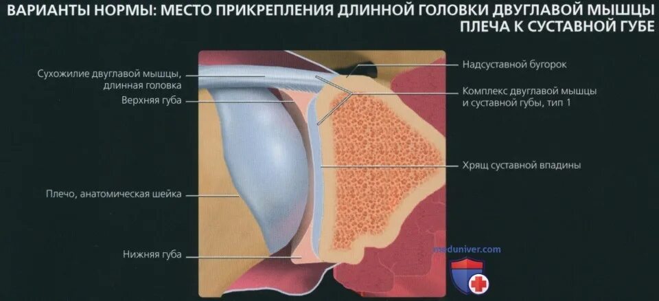 Изменение фиброзной губы гленоида. Пластика суставного хряща лопатки. суставная губа плечевого сустава. передний край хрящевой суставной губы. суставная губа плечевого сустава мрт.