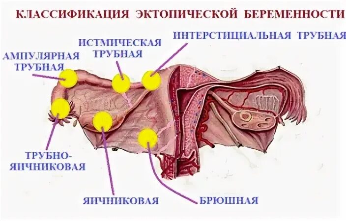 Риск внематочной беременности