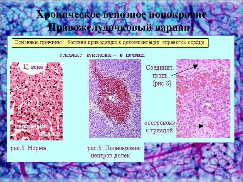 Хроническое полнокровие печени. Венозное полнокровие печени гистология. Микропрепарат полнокровие почки. Венозный застой печени микропрепарат. Венозное полнокровие печени микропрепарат.