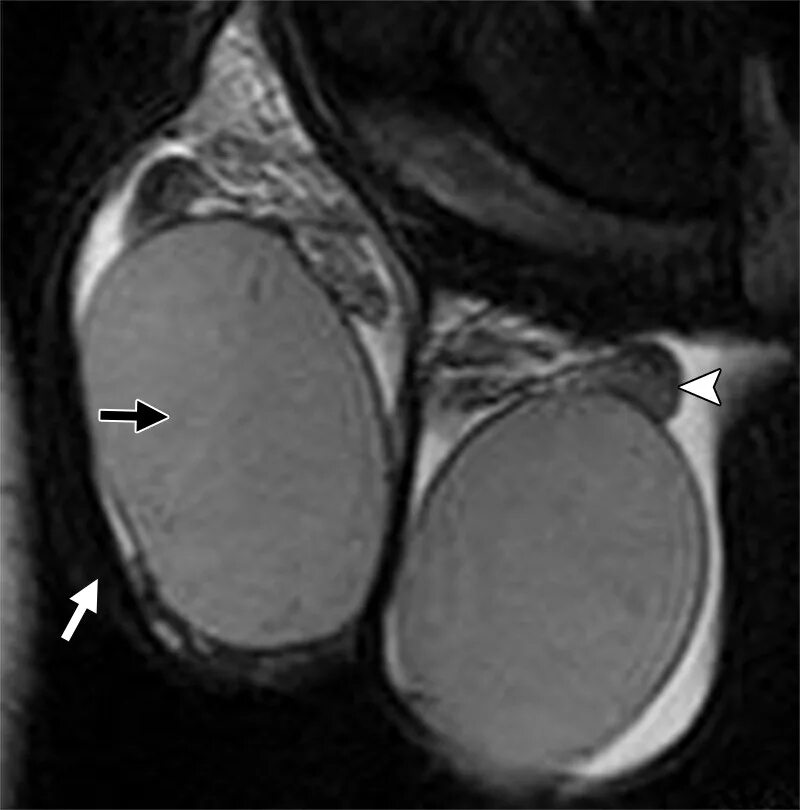 Гонококковый эпидидимит. Эпидидимит придатка яичка. Киста придатка яичка мрт. Киста придатка яичка на кт. Ниже яиц у мужчин