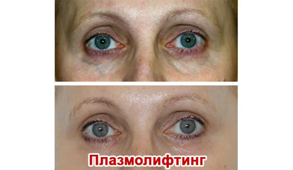 Блефаропластика Plasma Liner. Плазма лифтинг. Плазмолифтинг для лица. Плазма крови в лицо