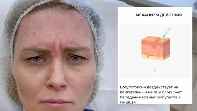 Миотокс отличие от ботокса. Ботокс миотокс. миотокс осложнения. миотокс под глазами.