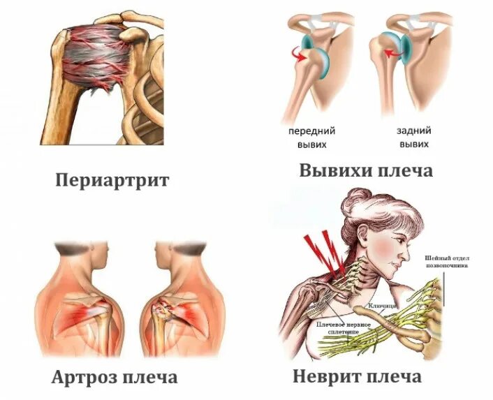 Болит плечо при поднятии. Плече периартрит плечелопаточный периартрит. Ьрлм в покчеврм суставе.