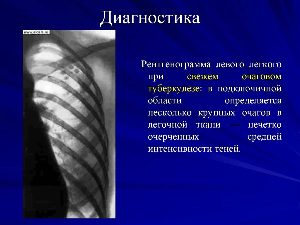 Тень в левом легком. Очаговый туберкулез рентген. Очаговая тень при туберкулезе. Очаговые тени в легких. Очаговая тень легкого.