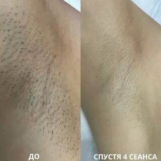 Эпиляция волос навсегда