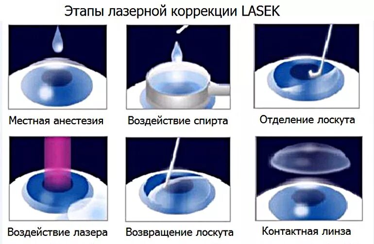 Лазерная коррекция зрения методом ФРК. Коррекция зрения по технологии ФРК (фоторефракционная кератэктомия). Коррекция зрения сравнение