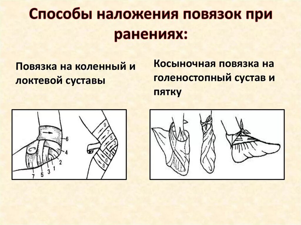 Наложение фиксирующей повязки на голеностопный сустав. Косыночная повязка наложение. Способы наложения повязок. Первая помощь наложение повязок. Какая повязка при повреждении голеностопного сустава