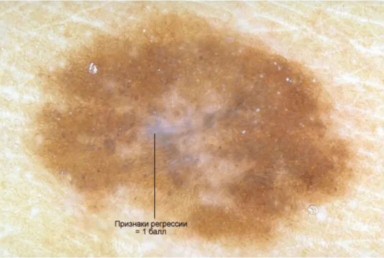 Распад кожи. Диспластический невус дерматоскоп. Беспигментная (амеланотическая) меланома. Пигментные диспластические невус. Пограничный невус дерматоскопия.