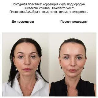 Делают контурную пластику лица