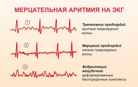 Экстрасистолия опасно ли для жизни