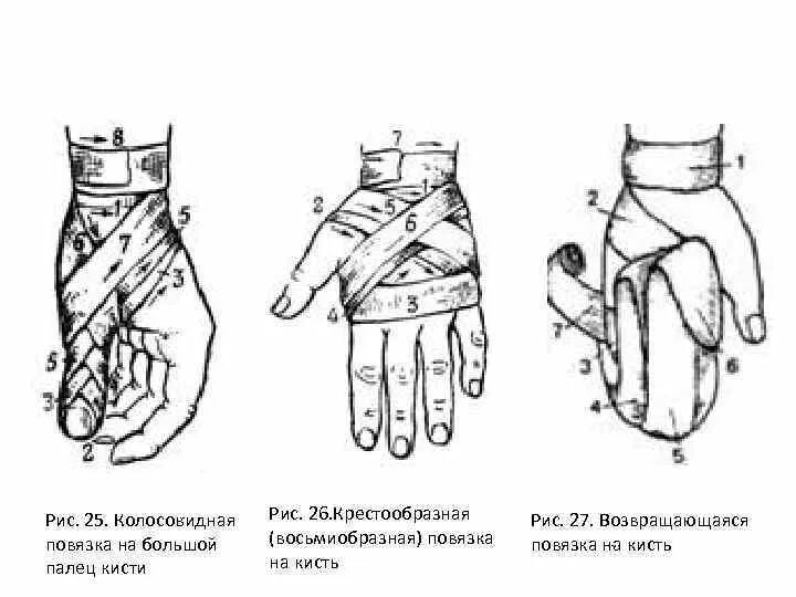 Техника наложения повязки на кисть
