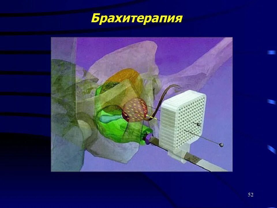 Брахитерапия это. Аппликационная брахитерапия. внутритканевая брахитерапия. брахитерапевтический аппарат.