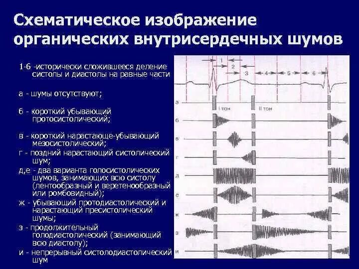 Классификация шумов сердца пропедевтика. Шумы сердца пропедевтика схема. Функциональные шумы ФКГ. Тоны и шумы сердца пропедевтика. Систолический шум это